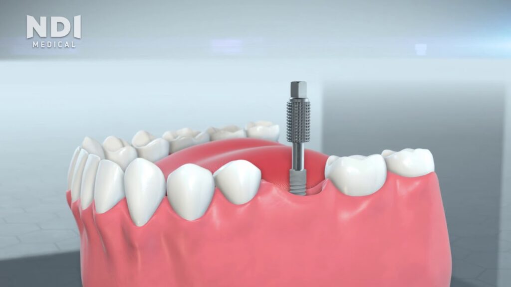 Signs of a failed dental implant that you need to know